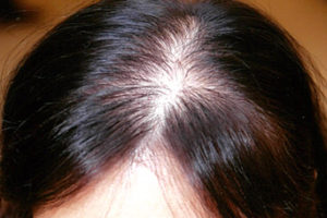 脫髮成因-頭皮敏感
