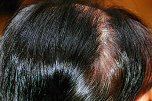 女性脫髮-內分泌失調-甩頭髮